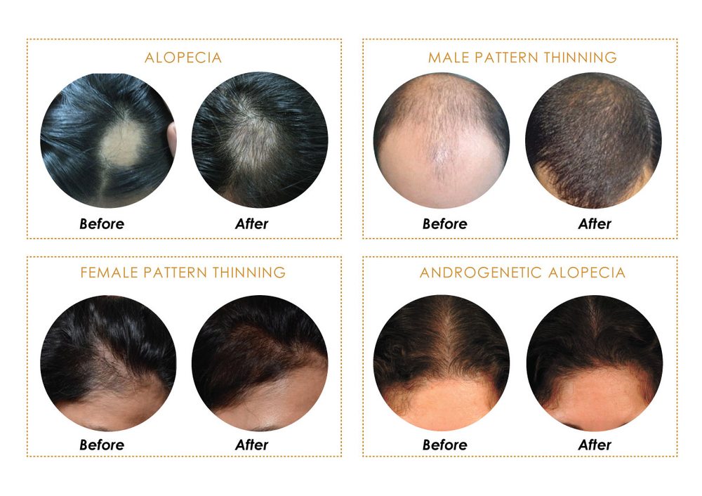 Ayurvedic Treatment For Hair Loss Problems Yelp