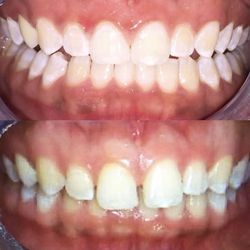 Scott Schwartz, DDS - Express Invisalign treatment