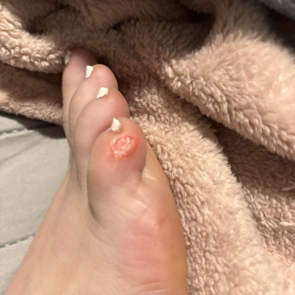 Forever Nails & Spa - Pinky toe sliced by callus remover. - Skin Care Near Me - Valencia, California Forever Nails & Spa - Pinky toe sliced by callus remover. - Skin Care Near Me - Valencia, California