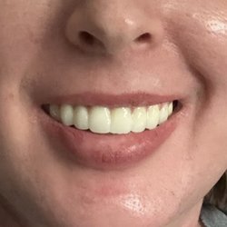 Ace Dental Center - New zirconia teeth all on x