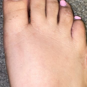 Gabriel J Halperin D.P.M. - FUNGUS: the after math of getting the root of my nail burnt on both sides! - Podiatrists Near Me - Los Angeles, California Gabriel J Halperin D.P.M. - FUNGUS: the after math of getting the root of my nail burnt on both sides! - Podiatrists Near Me - Los Angeles, California