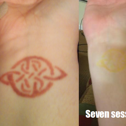 Red Celtic knot tattoo on my right wrist. The left is before, the right is after seven sessions at Vamoose. Red Celtic knot tattoo on my right wrist. The left is before, the right is after seven sessions at Vamoose.
