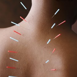Mahalo Massage Therapy and Wellness - Acupuncture Treatments