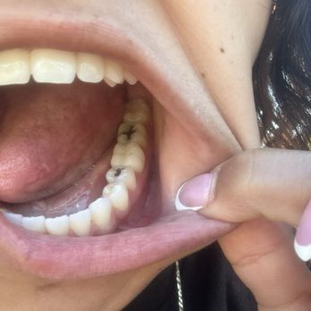 Elite Smiles - Finished crown - General Dentistry Near Me - Santa Clarita, California Elite Smiles - Finished crown - General Dentistry Near Me - Santa Clarita, California