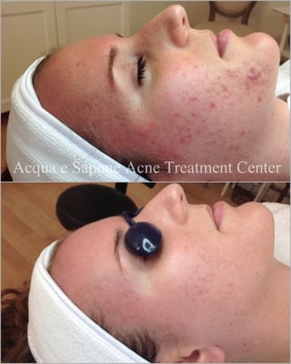 AES Acne Clinic by null