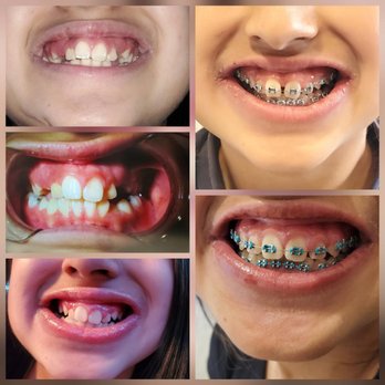Coastline Smiles - Ortho Before 2023 - Phase 1 + 2 - Pediatric Dentists Near Me - San Jose, California