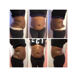 Natural Beauty Aesthetics - Before an after 2 sessions, 2 days apart!