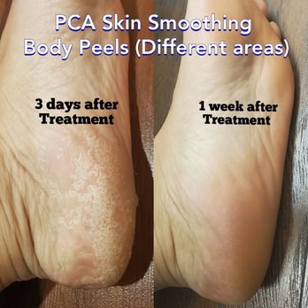 Pacific Pearl Spa - Pca Skin Body Peels!.
Call us for more information. - Skin Care Near Me - Nutley, New Jersey Pacific Pearl Spa - Pca Skin Body Peels!.
Call us for more information. - Skin Care Near Me - Nutley, New Jersey