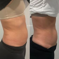 Illume Skin Spa - Before and After EMSculpt package