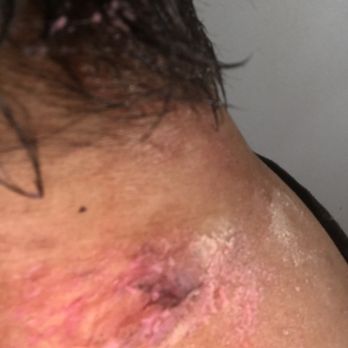 La Clínica Monument - Hmmm, looks like a f***** bug under my skin. I have been begging these doctors to help me. - Family Practice Near Me - Concord, California La Clínica Monument - Hmmm, looks like a f***** bug under my skin. I have been begging these doctors to help me. - Family Practice Near Me - Concord, California
