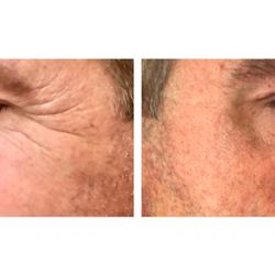 Vanishing Ink Med-Spa - Anti aging for men