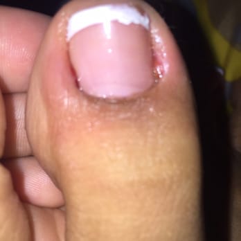 Lee’s Magic Nails - Pedicure gone wrong. Lady cut too much skin off. - Nail Salons Near Me - Panorama City, California