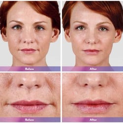 Glo MedSpa - We offer Juvederm® for the only lip injection proven to last for over a year!