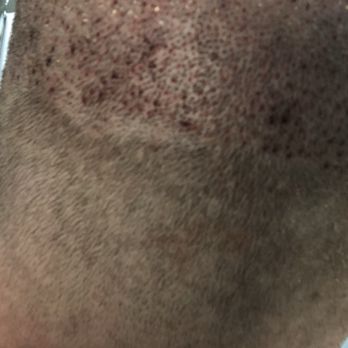 Neopel - The back of my head after the procedure - Hair Loss Centers Near Me - Tijuana, BCN