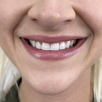 Vida Dentistry - After - Cosmetic Dentists Near Me - Mission Viejo, California Vida Dentistry - After - Cosmetic Dentists Near Me - Mission Viejo, California
