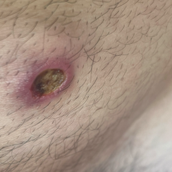 Raskin Damon, MD - $1500 scar I have from a wound that won't fully heal due to the fact they had an underqualified employee perform my medical procedure