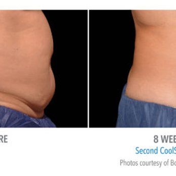 Buffalo Laser Spa - Laser Hair Removal Near Me - Williamsville, New York