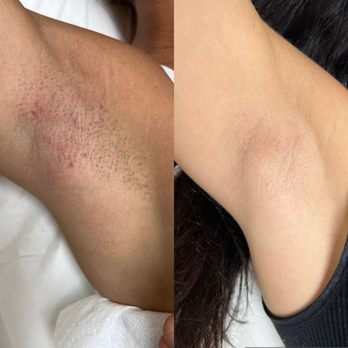 Laser by Nicole - Before and after - Underarms - Laser Hair Removal Near Me - Oakland Park, Florida Laser by Nicole - Before and after - Underarms - Laser Hair Removal Near Me - Oakland Park, Florida