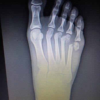 Steven Shoemaker, DPM, FACFAS - Original break, then ended up with two pins that were removed, one screw and then a play and screws on the pinky. - Podiatrists Near Me - Roseville, California Steven Shoemaker, DPM, FACFAS - Original break, then ended up with two pins that were removed, one screw and then a play and screws on the pinky. - Podiatrists Near Me - Roseville, California