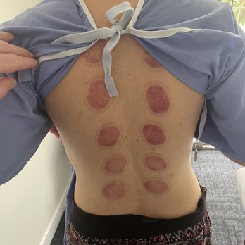 Simple Health Acupuncture & Chiropractic - Cupping - Acupuncture Near Me - Long Beach, California