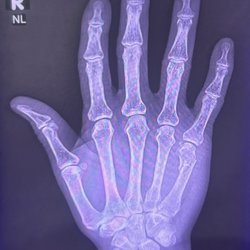 Progressive Urgent & Primary Care - Broken pinky :(