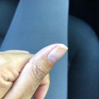 OMG Nails & Spa - 3/3 infected nails - Nail Salons Near Me - Chandler, Arizona OMG Nails & Spa - 3/3 infected nails - Nail Salons Near Me - Chandler, Arizona