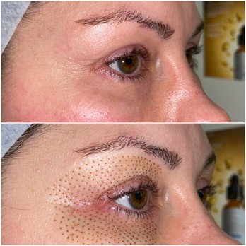 Prolase Medispa - Laser Hair Removal Near Me - Fairfax, Virginia