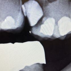 JR Dental - This is an x-ray of a tooth. Then he said it had been shipped and needed to be removed a molar.