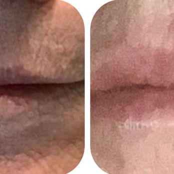 K-Method Medspa - One syringe of Filler. 66 year old who has smoked since a teenager - Medical Spas Near Me - Elk Grove, California K-Method Medspa - One syringe of Filler. 66 year old who has smoked since a teenager - Medical Spas Near Me - Elk Grove, California