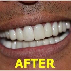 Precilyn B Silvestre, DDS - AFTER