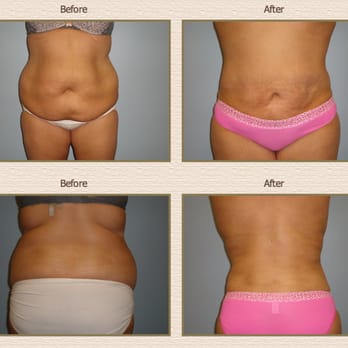 Rocheford Plastic Surgery - Liposuction Before and After - Cosmetic Surgeons Near Me - Woodbury, Minnesota