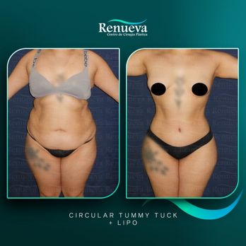 Clínica Renueva - 360 Tummy tuck with lipo from arms, full back, flanks and fat transfer to buttocks - Cosmetic Surgeons Near Me - Tijuana, BCN Clínica Renueva - 360 Tummy tuck with lipo from arms, full back, flanks and fat transfer to buttocks - Cosmetic Surgeons Near Me - Tijuana, BCN