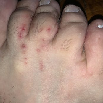 Hampton Inn Key Largo, FL - Skin mites on my feet from whatever it is my cat contracted from this place - Hotels Near Me - Key Largo, Florida Hampton Inn Key Largo, FL - Skin mites on my feet from whatever it is my cat contracted from this place - Hotels Near Me - Key Largo, Florida