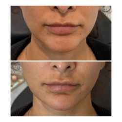 Skin Fit LA - Juverderm voluma 1ml chin filler
