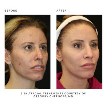 Nava Aesthetics - Before and After Salt Facial® treatments - Medical Spas Near Me - Madison, Alabama Nava Aesthetics - Before and After Salt Facial® treatments - Medical Spas Near Me - Madison, Alabama