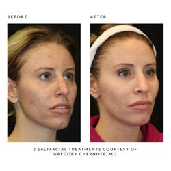Nava Aesthetics - Before and After Salt Facial® treatments