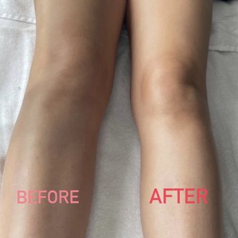 Lux Sculpting Lounge - lymphatic massage on the legs is to boost the lymphatic system and drain excess fluid. You can see the huge difference. - Medical Spas Near Me - West Covina, California Lux Sculpting Lounge - lymphatic massage on the legs is to boost the lymphatic system and drain excess fluid. You can see the huge difference. - Medical Spas Near Me - West Covina, California