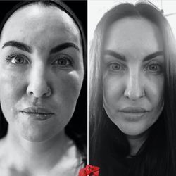 Infusions & Injections - Lip plumping treatment, before & immediately after. Volbella lip filler.