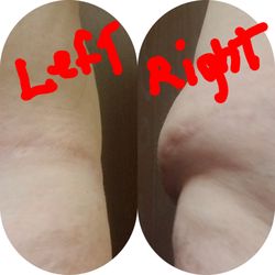 Bryce D. Allred, MD - Botched tummy tuck.. left side vs right side after surgery