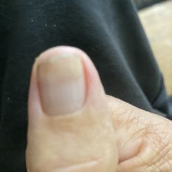 Napa Valley Nails - Split fingernail after Ana repaired it. Wow!