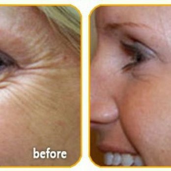 Re-Nu Aesthetics - Dysport before and after. Get rid of those old crows feet! - Medical Spas Near Me - Tucson, Arizona
