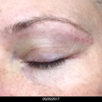 Brow Art 23 - 24 hrs after. She broke the thread TWICE!! - Hair Removal Near Me - Altamonte Springs, Florida Brow Art 23 - 24 hrs after. She broke the thread TWICE!! - Hair Removal Near Me - Altamonte Springs, Florida