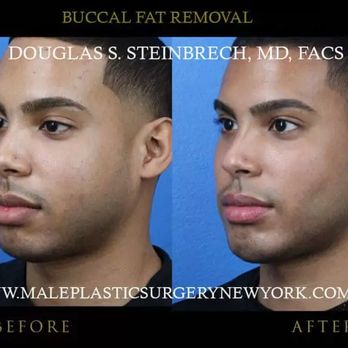 Male Plastic Surgery - Buccal fat removal before and after photo - Plastic Surgeons Near Me - New York, New York Male Plastic Surgery - Buccal fat removal before and after photo - Plastic Surgeons Near Me - New York, New York