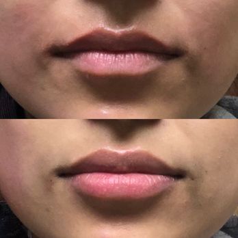 Robert F Gray, MD, FACS - Before and after - Cosmetic Surgeons Near Me - Pleasanton, California Robert F Gray, MD, FACS - Before and after - Cosmetic Surgeons Near Me - Pleasanton, California