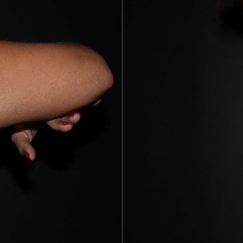 Neinstein Plastic Surgery - Pre-Op (With PAH Coolsculpting Deformity) - Plastic Surgeons Near Me - New York, New York