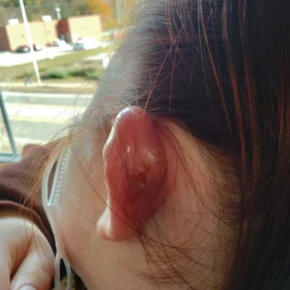 Medusa - This was at the doctors - Piercing Near Me - Manchester, New Hampshire