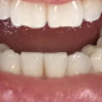 Lake Forest Dental Associates - Before - General Dentistry Near Me - Lake Forest, Illinois Lake Forest Dental Associates - Before - General Dentistry Near Me - Lake Forest, Illinois