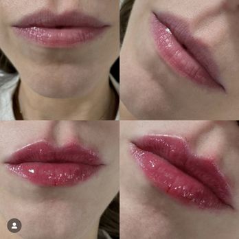 LYEV Beverly Hills - Before & after lip filler with Sumaira at LYEV! We did 1/2 syringe of Juvaderm! - Medical Spas Near Me - Beverly Hills, California LYEV Beverly Hills - Before & after lip filler with Sumaira at LYEV! We did 1/2 syringe of Juvaderm! - Medical Spas Near Me - Beverly Hills, California