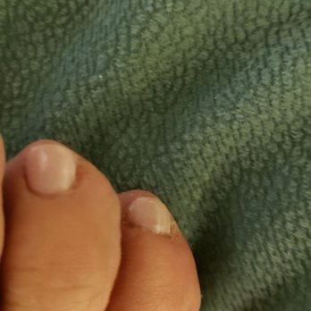 Rossys Nail Bar - Inflamed toes. - Nail Salons Near Me - Mahopac, New York