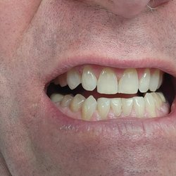 Dentistry of Venice - my 60 year old choppers (actually two are my BABY teeth so maybe pushing 64 years old!!!)